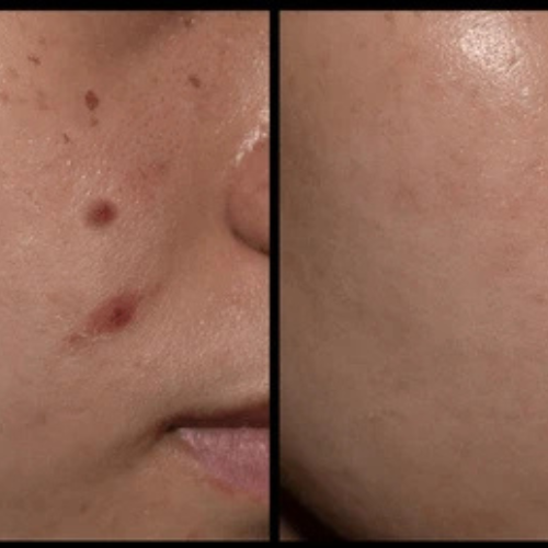 Acne Pimple Patches
