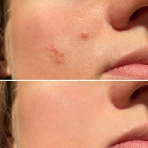 Acne Pimple Patches