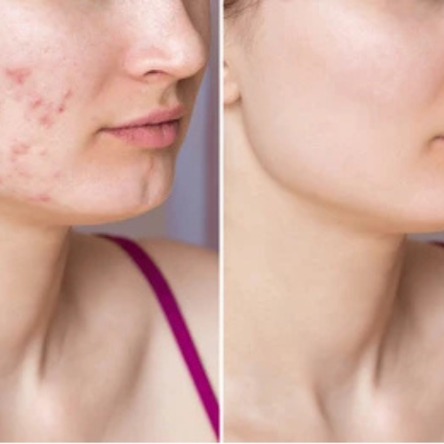 Acne Pimple Patches