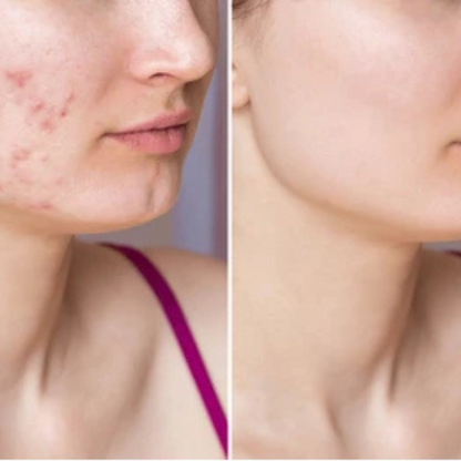 Acne Pimple Patches