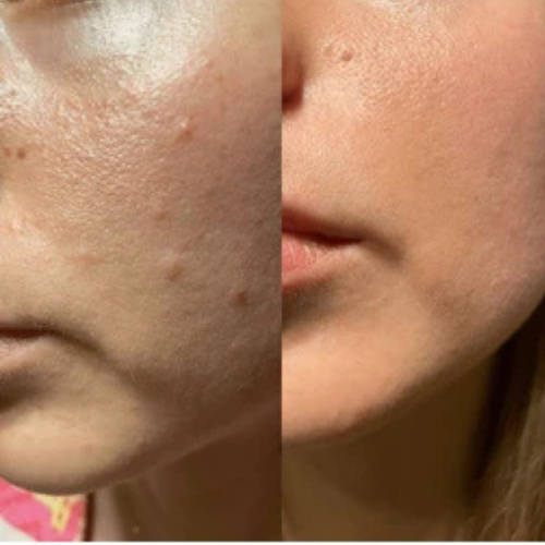Acne Pimple Patches